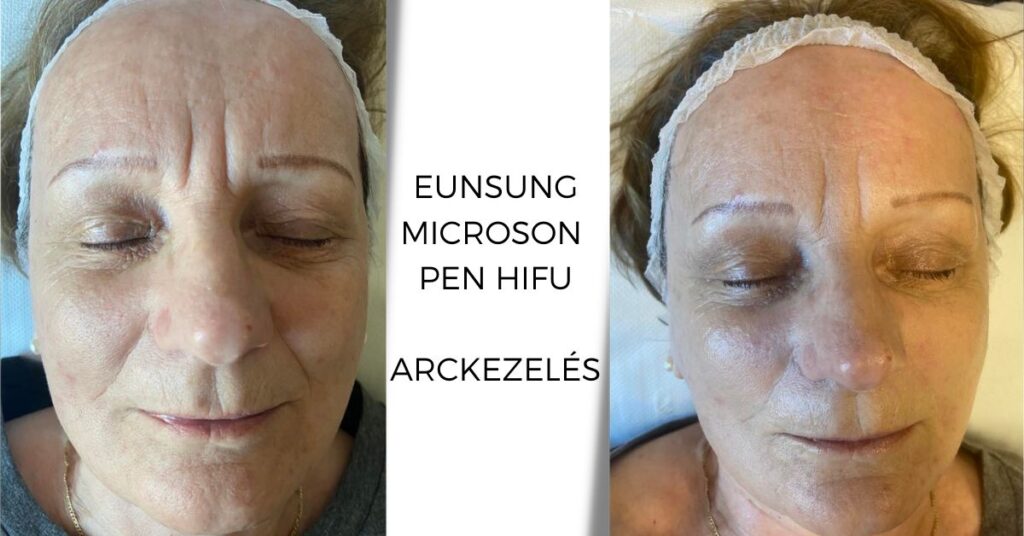 Hol hat a HIFU és mennyi ideig tart az arcfiatalító kezelés hatása?