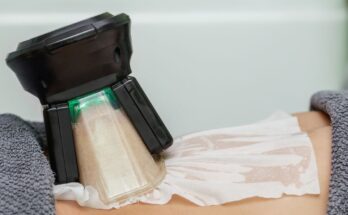 Kriolipolízis, azaz a híres zsírfagyasztás Békéscsabán