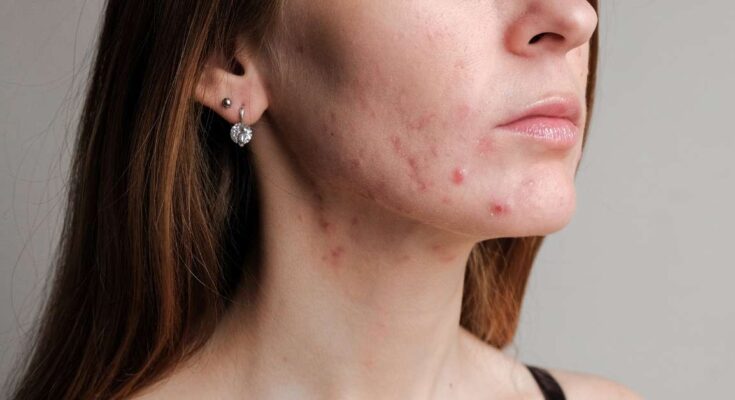 akne bőr kezelése érden