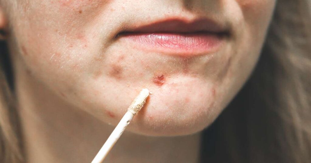 akne bőr kezelése érden-ebony