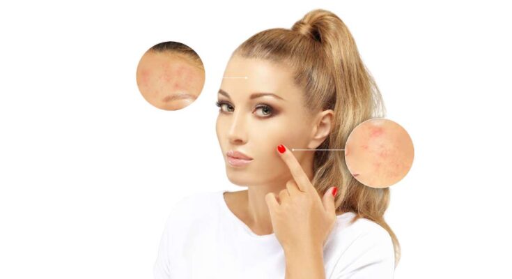 pattanás ellen a szoláriumozás a megoldás